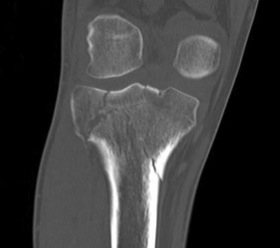 Tibial Plateau Type V